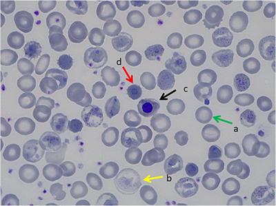 Usefulness of NGS for Diagnosis of Dominant Beta-Thalassemia and Unstable Hemoglobinopathies in Five Clinical Cases